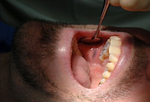 Amalgam tattoo is a harmless stain from the amalgam in fillings.