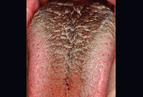 Mouth Patch Symptom Thrush