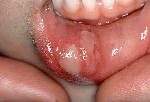 Sore tongue after kissing