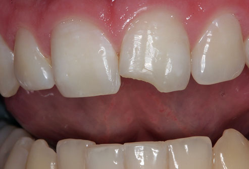 Not all chips and cracks in your teeth need treatment, but most do.