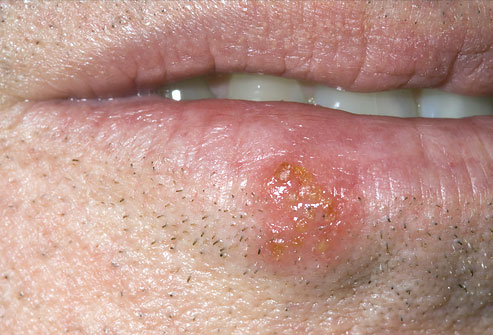 Baby Herpes Pictures on Herpes Lips Babies   Early Herpes On Lips   Causes And Treatment