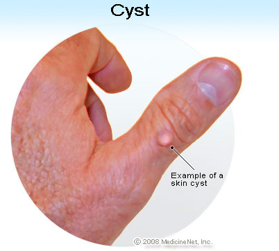 What are the types of cysts? - WebMD Answers