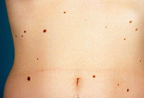 Red Moles On Skin