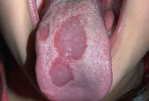 tongue blister