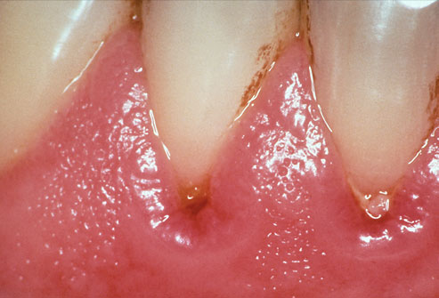 How To Fight Gingivitis. Prevent gingivitis by brushing
