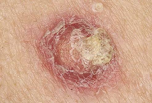 Skin Cancers