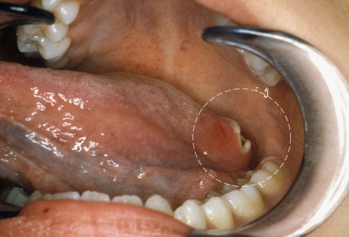 Don't ignore mouth sores that linger for weeks; they could be cancer.